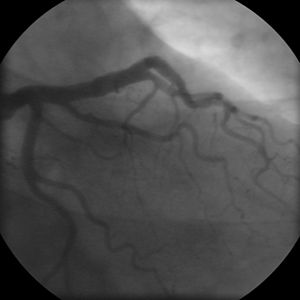 Coronary angiogram of a man