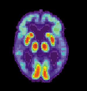English: PET scan of a human brain with Alzhei...