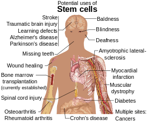 New stem cell gene therapy gives hope to prevent inherited neurological disease
