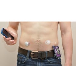 Artificial pancreas: the way of the future for treating type 1 diabetes