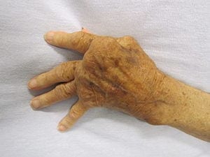 New research claims rheumatoid arthritis breakthrough