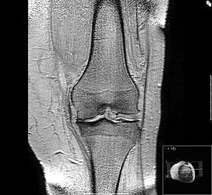 Platelet-rich Plasma (PRP) Treatment Shows Potential for Knee Osteoarthritis
