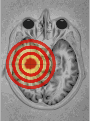 New MRI method fingerprints tissues and diseases