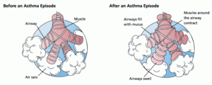 Physician reveals drug breakthrough for asthma patients