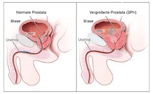 Nonsurgical treatment turns back the clock, shrinks enlarged  prostate