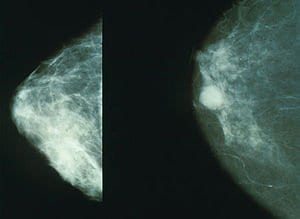 300px-Mammo_breast_cancer