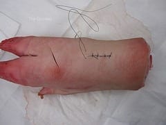 New Antibacterial Coating for Sutures Could Reduce Infections After Surgery