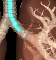 Researchers Devise X-ray Approach to Track Surgical Devices and Minimize Radiation Exposure