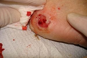 Discovery of a novel medicine for the treatment of chronic wounds