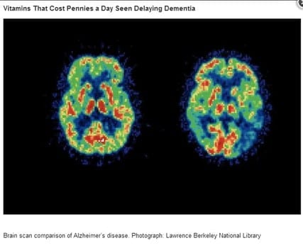 Vitamin B for Alzheimer's and dementia delay and protection, new research study
