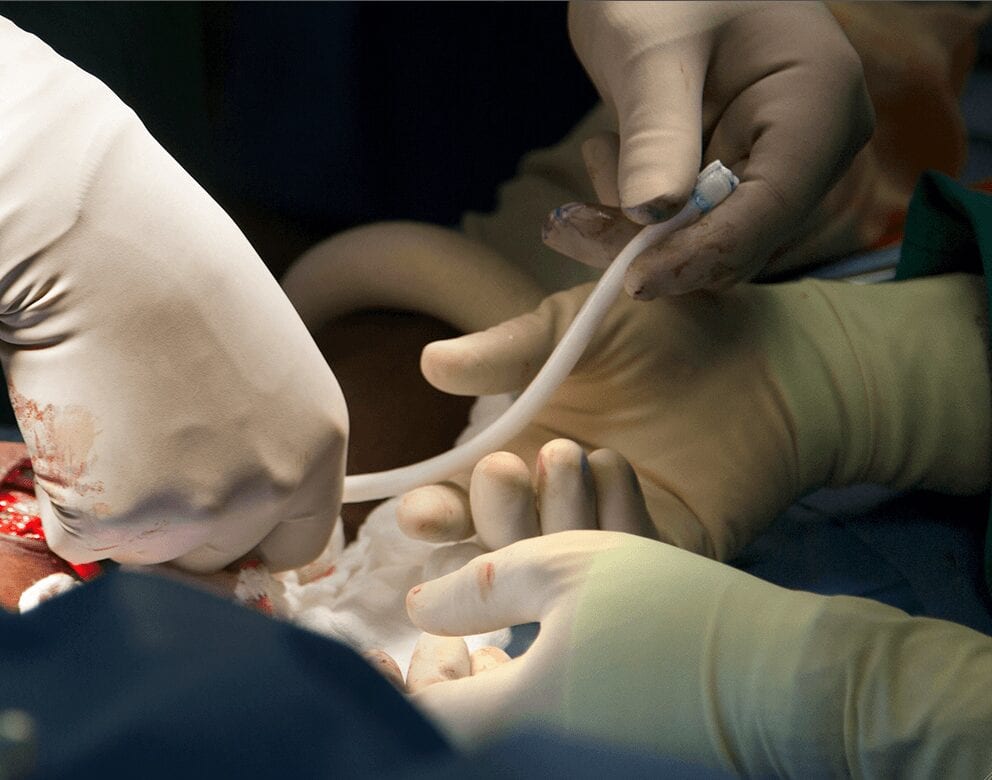 Surgeons at Duke University Hospital Implant Bioengineered Vein
