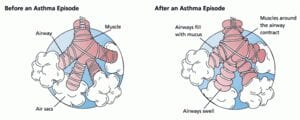 A promising target to treat asthma