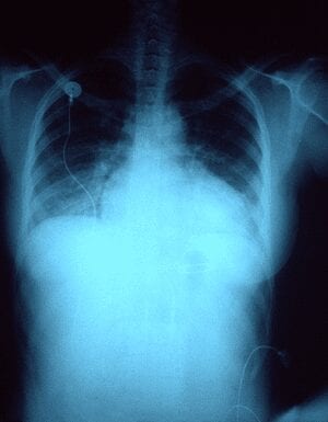 Inhalable Gene Therapy May Help Pulmonary Arterial Hypertension Patients