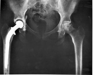 Southampton engineers develop novel method to increase lifespan of joint replacements