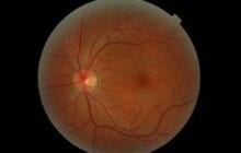 Your eyes may hold clues to stroke risk
