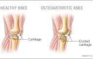 Bisphosphonates could offer effective pain relief in osteoarthritis