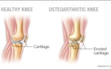 Bisphosphonates could offer effective pain relief in osteoarthritis