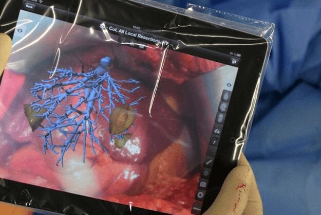 Augmented Reality App Guides Surgeons During Tumor Removal