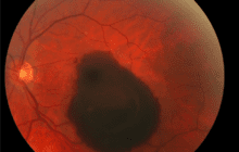 UNC research points to promising treatment for macular degeneration