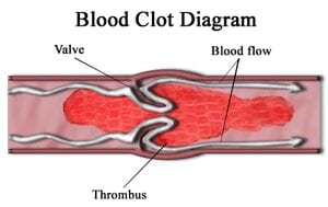 Toward a urine test for detecting blood clots