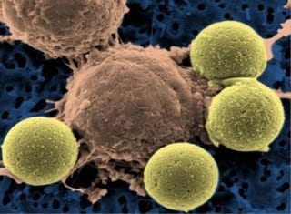 Genetically Modified T Cells Induced Complete Remissions in 88 Percent of Advanced Leukemia Patients Treated