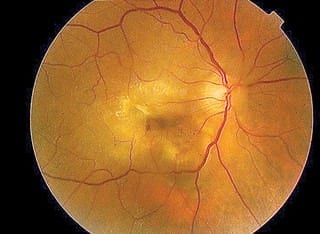 Researchers make major breakthrough in treatment for age-related blindness