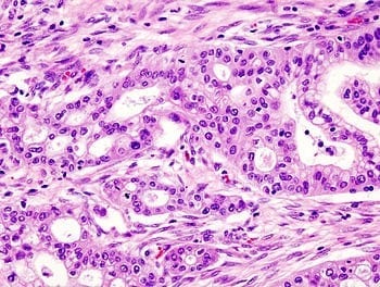 Bacteria in Mouth May Diagnose Pancreatic Cancer