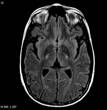 English: Amyotrophic lateral sclerosis MRI (axial FLAIR) demonstrates increased T2 signal within the posterior part of the internal capsule, consistent with the clinical diagnosis of ALS source:Radiopedia.org (Photo credit: Wikipedia)