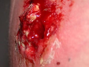 English: A ruptured MRSA cyst. (Photo credit: Wikipedia)