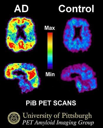 English: This image shows a PiB-PET scan of a patient with Alzheimer's disease on the left and an elderly person with normal memory on the right. Areas of red and yellow show high concentrations of PiB in the brain and suggest high amounts of amyloid deposits in these areas. (Photo credit: Wikipedia)