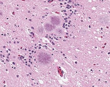 Variant Creutzfeldt-Jakob disease (vCJD), typical amyloid plaques, H&E (Photo credit: Wikipedia)