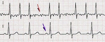 First evidence for painless atrial fibrillation treatment