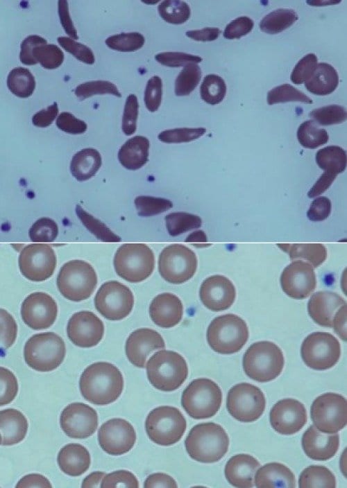 Top image: The magnified blood of a patient with severe sickle cell disease. Bottom image: The blood of a patient with sickle cell disease after undergoing the partial transplant. Credit: NIH Molecular and Clinical Hematology Branch