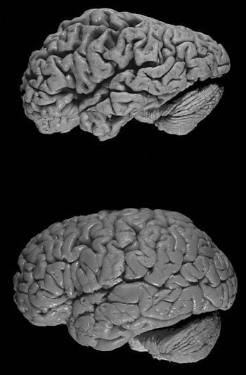 Healthy brain (bottom) versus brain of a donor with Alzheimer's disease. Notable is the "shrink" that has occurred in Alzheimer's disease; the brain was decreased in size. (Photo credit: Wikipedia)