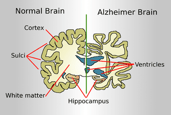 English: Drawing comparing how a brain of an Alzheimer disease patient is affected to a normal brain (Photo credit: Wikipedia)