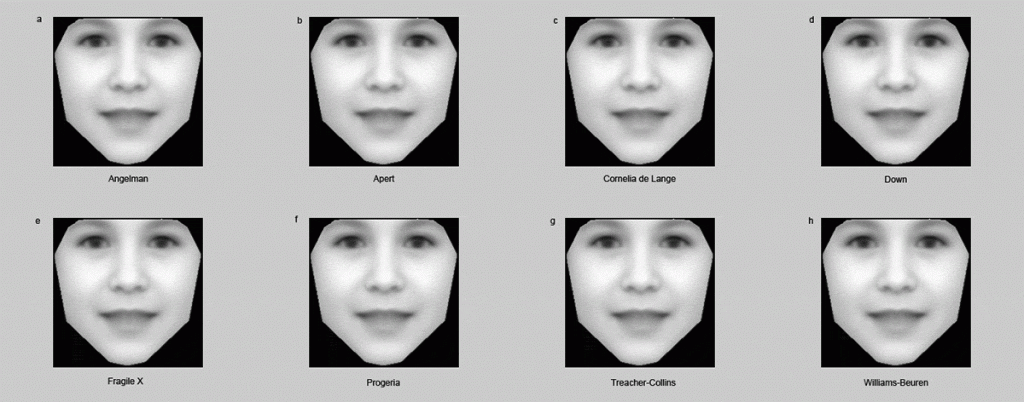 Each of the disorders used to train the software affects a face differently 