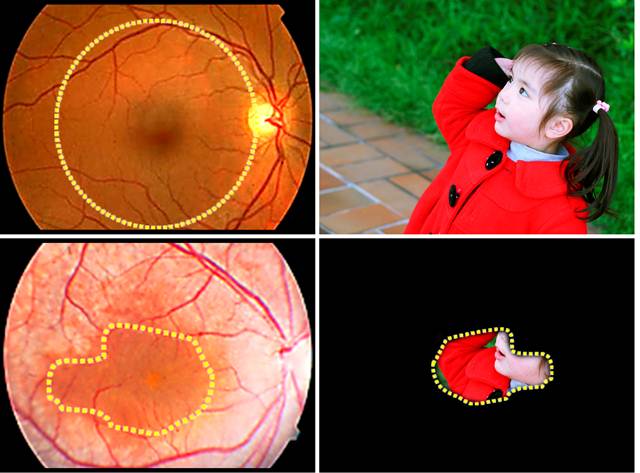 Images of normal (above) and diseased retinas. Patients with MFRP mutations, a cause of retinitis pigmentosa, lose the function of most retinal cells, particularly at the periphery of the retina, leaving them with drastically reduced vision. Personalized gene therapy, using iPS cells, may offer a way to correct this genetic disorder. (Image credit: Lab of Stephen H. Tsang, MD, PhD/Columbia University Medical Center.)