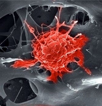 Electron micrograph of an osteoblast cell expanding on the implant by grabbing onto the pores.