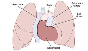 Schematic of a transplanted heart with native lungs and the great vessels. (Photo credit: Wikipedia)