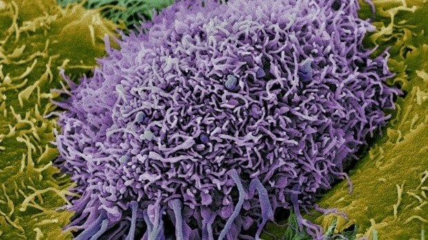 'Huge breakthrough' in understanding how the immune system recognises cancer