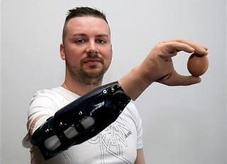 Scientists report bionic hand reconstruction in three Austrian men