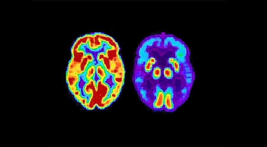 Alzheimer's breakthrough drug may 'dramatically change' treatment