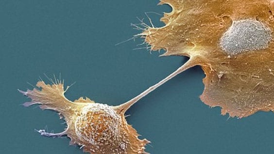 Pancreatic cancer breakthrough: scientists turn cancer cells into normal cells