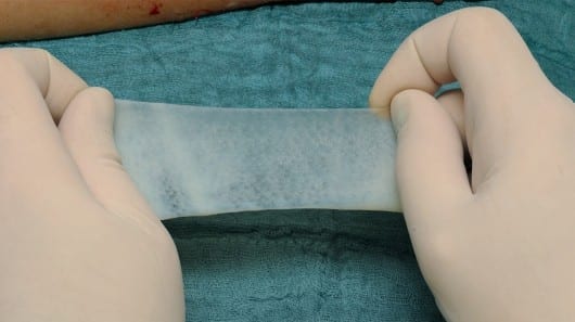 In the not-too-distant future, burn victims may be able to recover in the half the time than is possible today. If so, it will be thanks to a biodegradable dressing that applies cultured skin cells directly to the wound site. The biomaterial is being developed in a collaboration between Mexico's Autonomous University of the State of Morelos (UAEM) and the Scientific Research Centre of Yucatan. Led by UAEM's Prof. Jesús Santa-Olalla Tapia, the researchers have isolated skin cells (keratinocytes), grown colonies of them in the lab, and then applied them to a gauze-like dressing. When applied to burns, the material delivers the cells right to the wound, where they release proteins that trigger skin growth. Additionally, because the material simply biodegrades in place on the wound, the dressing never needs to be changed – doing so can sometimes set back the healing process, even though it's necessary with regular dressings. As a result, when tested on small burns on rabbits and mice, the material reportedly reduced healing time by 50 percent. Plans now call for testing on larger animals, followed by human trials. Read more: Skin cell-laced dressing reduces burn healing time by half