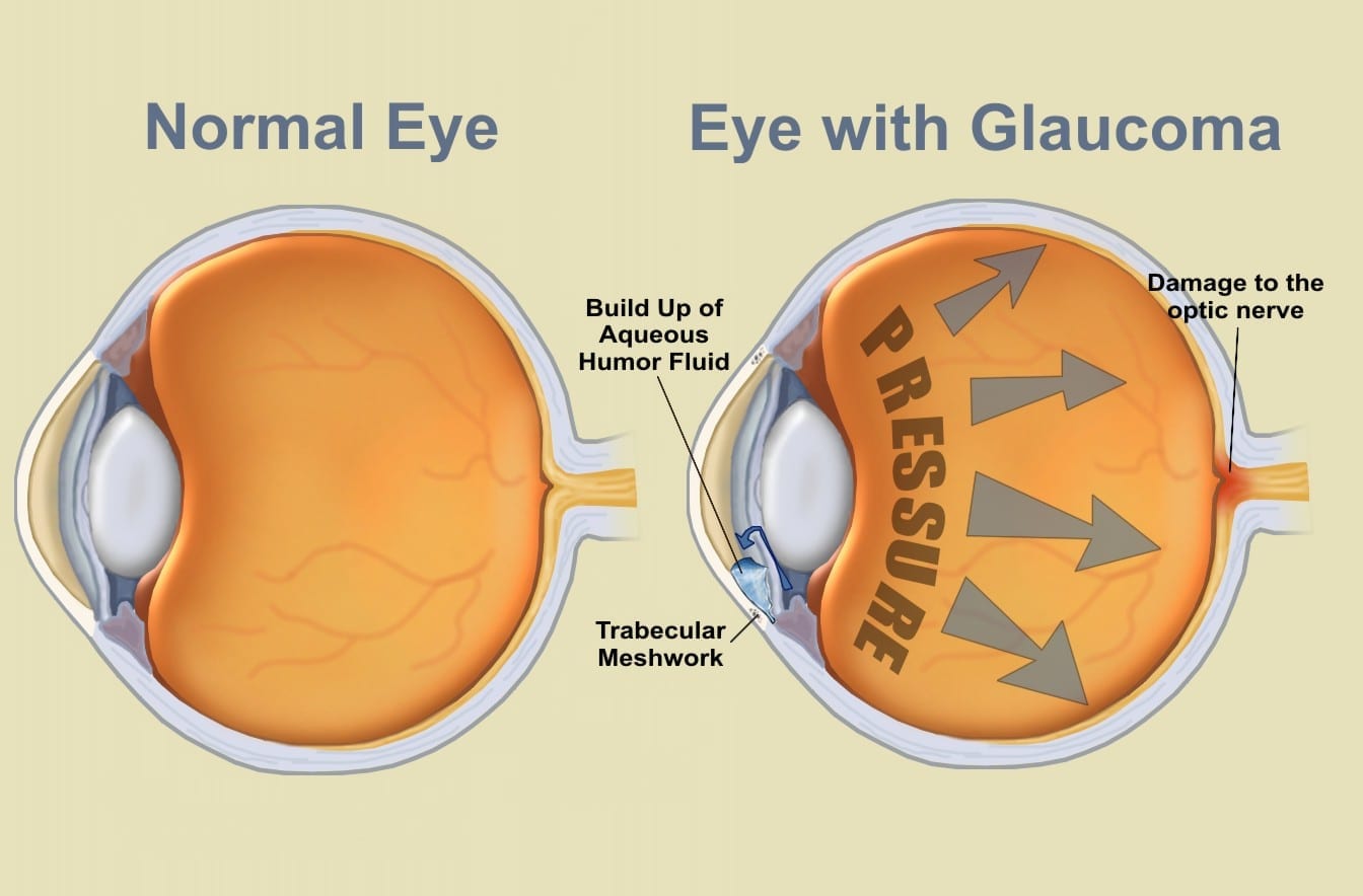 Herbal Supplement May Successfully Treat Glaucoma