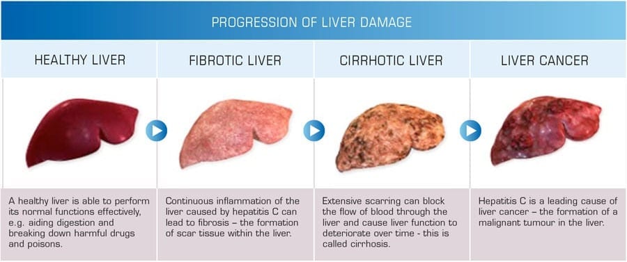 Researchers Test Bioartificial Liver Device to Treat Acute Liver Failure