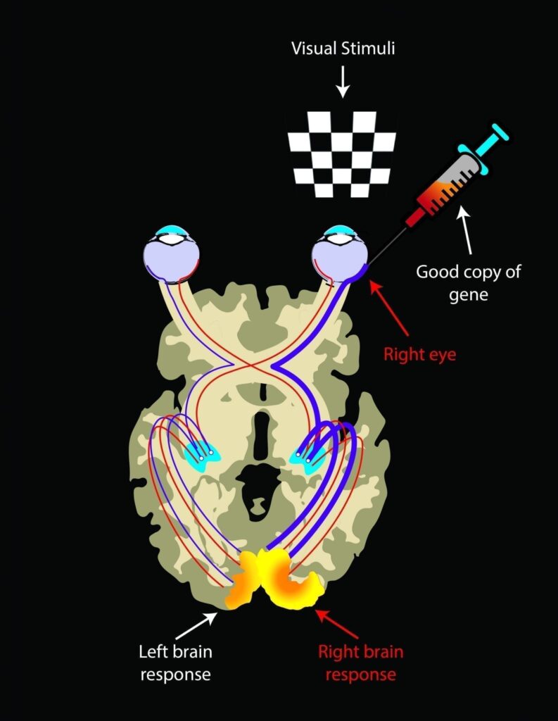 Being a bilateral disease, visual pathways in LCA2 patients on both sides are atrophied due to lack of visual inputs. After reinstating vision by injection of good copies of the gene, visual pathways from the injected area to the brain strengthen over time. Hence there is an asymmetrical brain response showing much larger activations in the retina-brain pathway from the injected eye when each eye is exposed to visual stimuli. Illustrated by Elena Nikonova