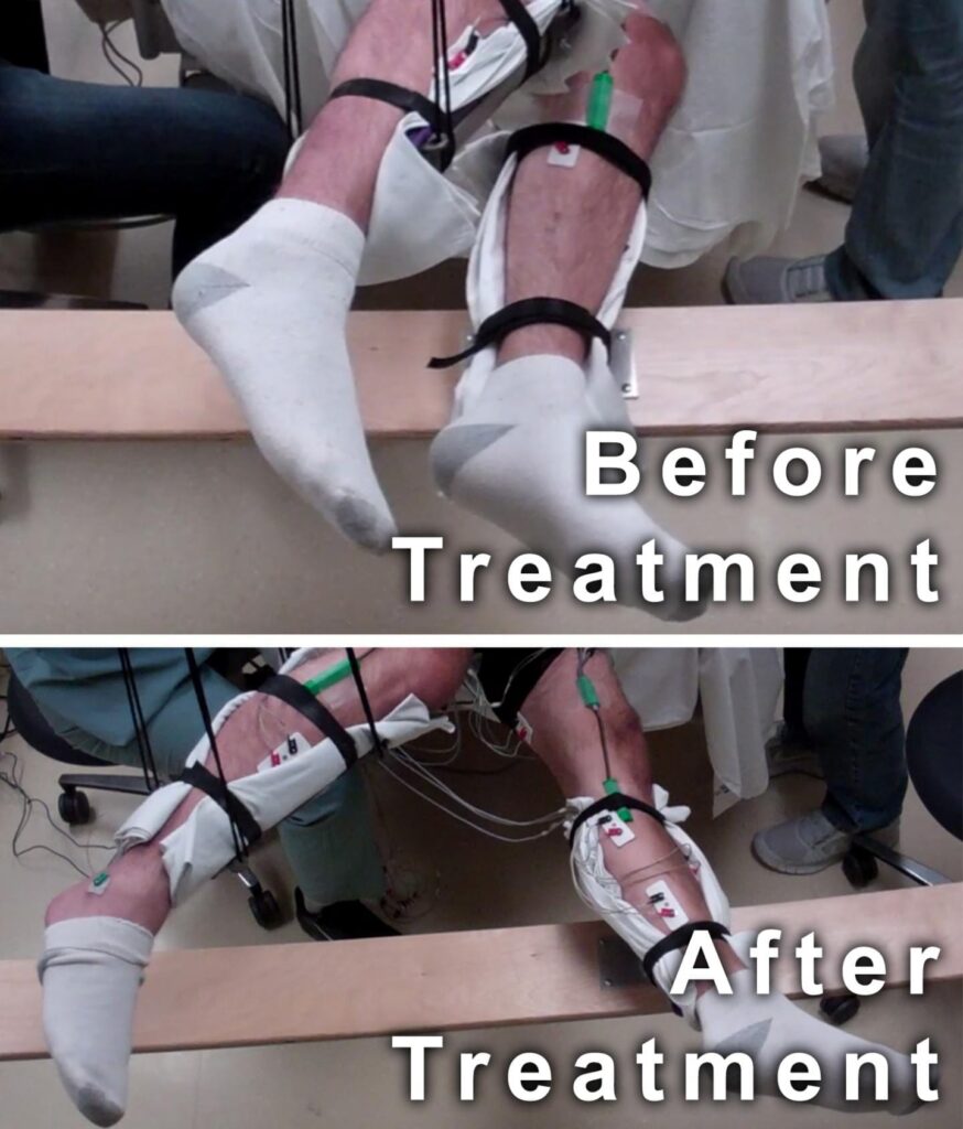 This image shows the range of voluntary movement prior to receiving stimulation compared to movement after receiving stimulation, physical conditioning, and buspirone. The subject's legs are supported so that they can move without resistance from gravity. The electrodes on the legs are used for recording muscle activity. CREDIT Edgerton lab/UCLA