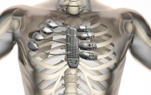 Here’s how the 3D printed sternum and rib cage fit inside the patient’s body.