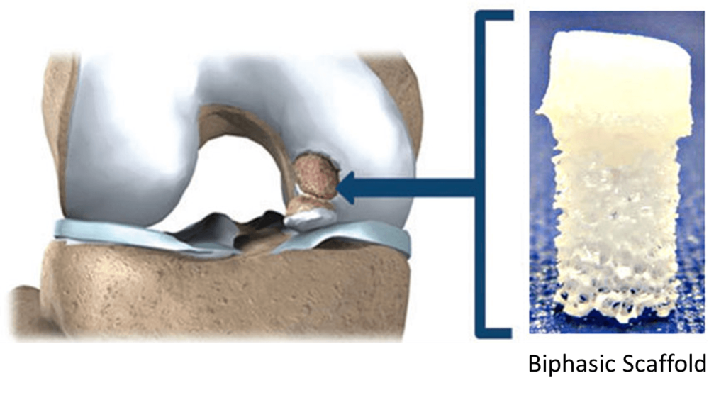 Biphasic silk and ceramic scaffold is designed to mimic properties of cartilage and bone for grafting into damaged joint. Source: Springer Science